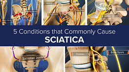 Five conditions that commonly cause sciatica slideshow cover