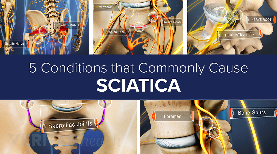 Slideshow: 5 Conditions that Commonly Cause Sciatica