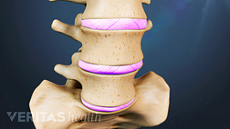 Slipped disc in the lumbar spine