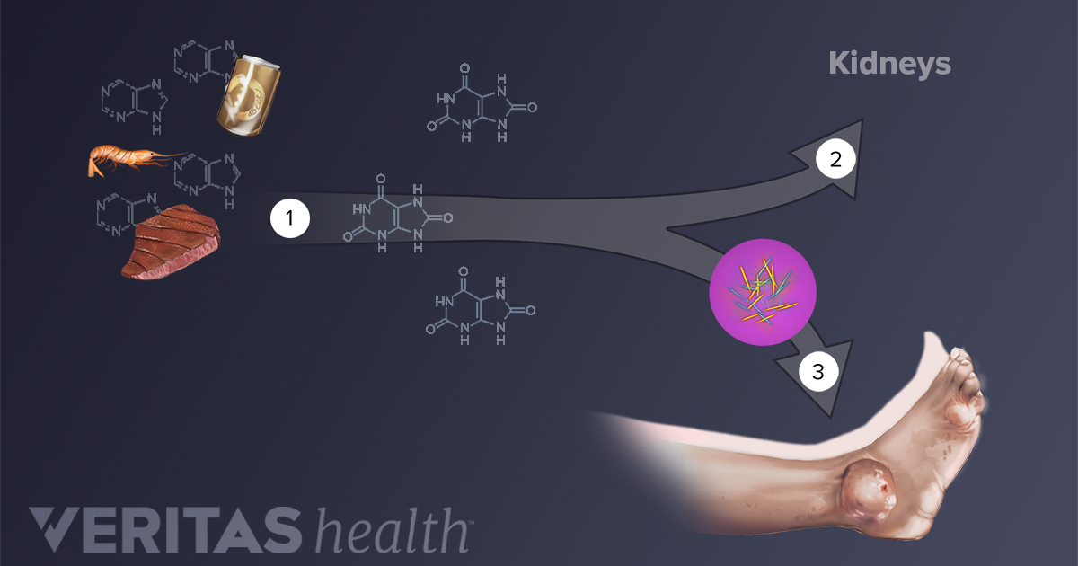 Hyperuricemia - High Uric Acid Levels And Gout