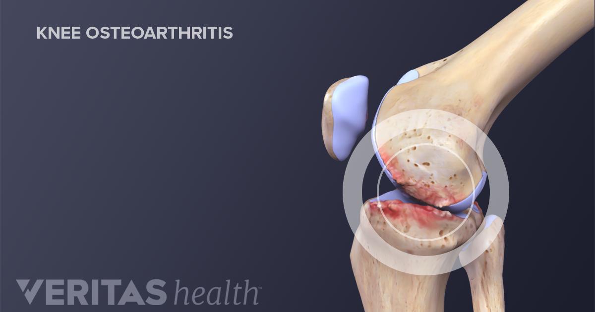 knee cap disorders