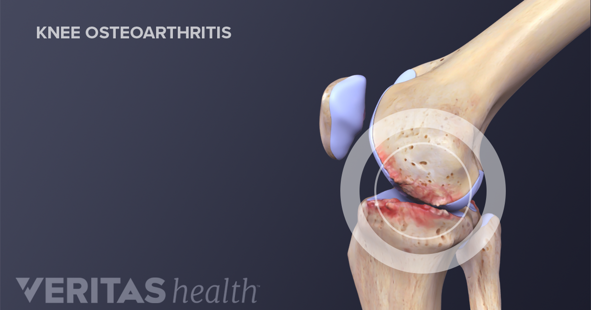 patella arthritis