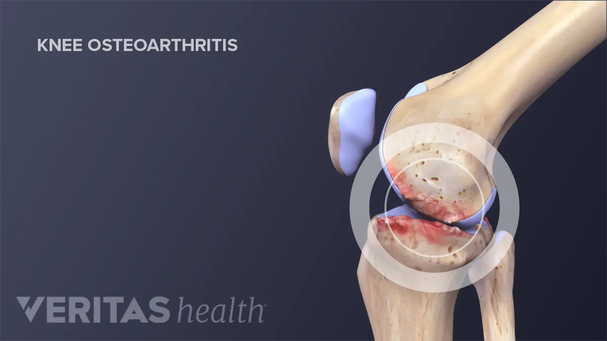 Knee Osteoarthritis.webp