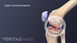 Medical illustration showing inflammation in a knee joint due to osteoarthritis