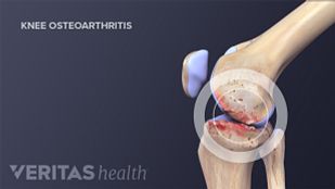 Crepitus In The Knee | Arthritis-Health