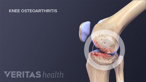 Crepitus In The Knee | Arthritis-Health