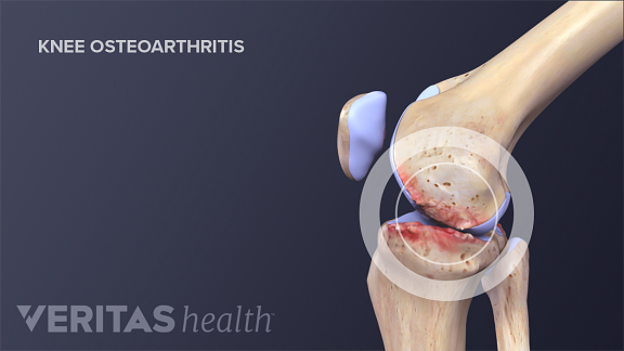 Illustration of knee joint degeneration due to osteoarthritis