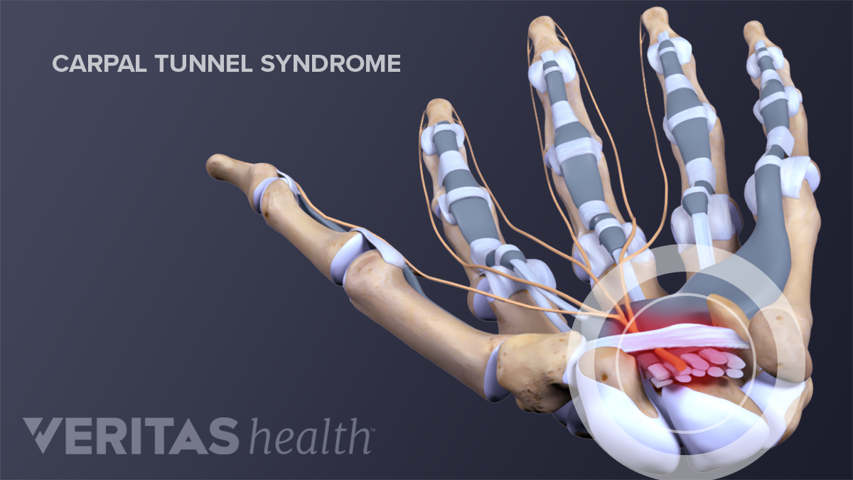 Carpal artrosis kezelés, Nem múló carpalis alagút szindróma gyógyítása