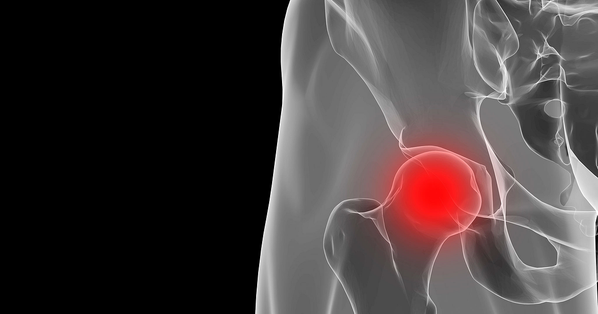 Hip Bursitis Treatment 