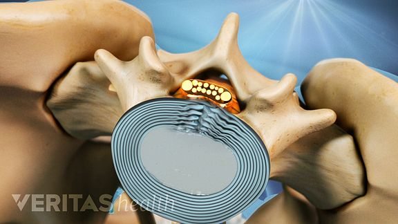 Cauda equina syndrome is often caused by disc herniation.
