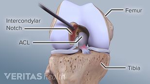 Which ACL Graft Is Right for You?