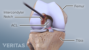 4 Risk Factors for ACL Injuries That You Need to Know