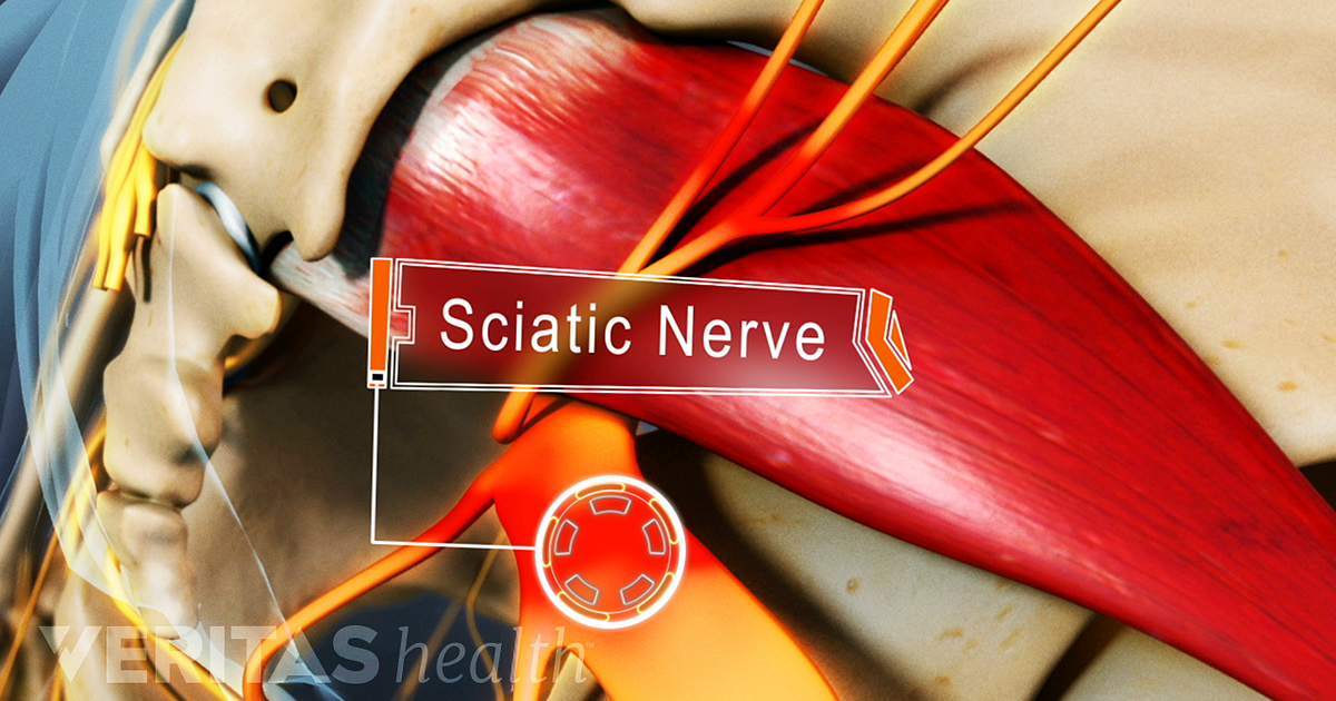 What You Need To Know About Sciatica