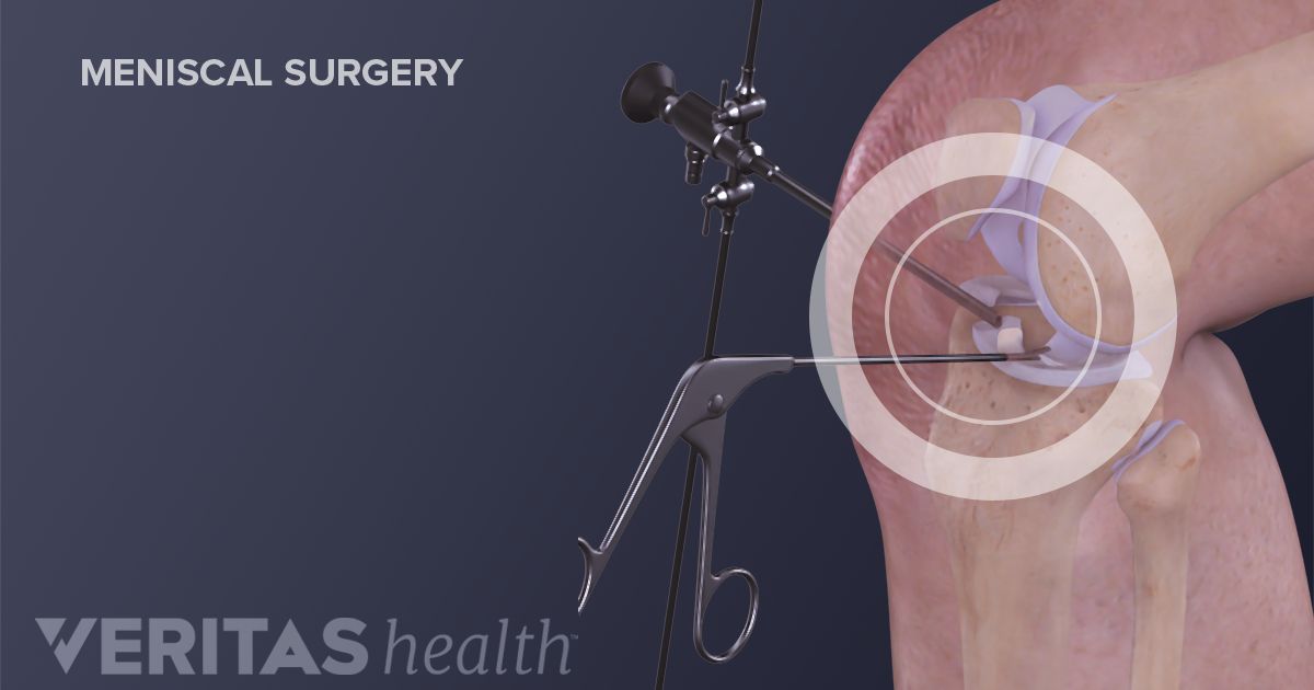 Should You Have Knee Meniscus Repair Surgery?