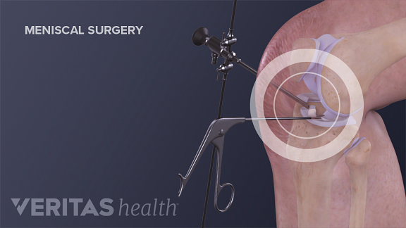 meniscal surgery