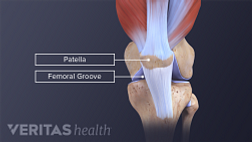 Anterior and profile view of a normal patellofemoral alignment labeling patella and femoral groove.