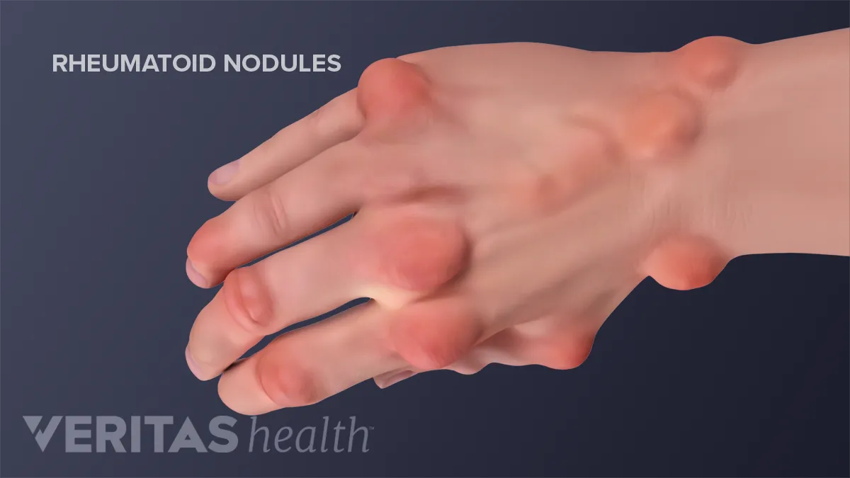 Therapy For Rheumatoid Arthritis In The Hand 60 OFF