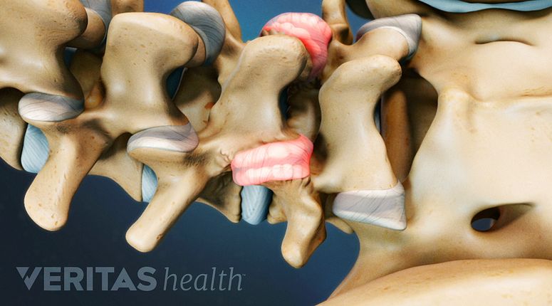 Cervical, Thoracic and Lumbar Facet Joint Injections