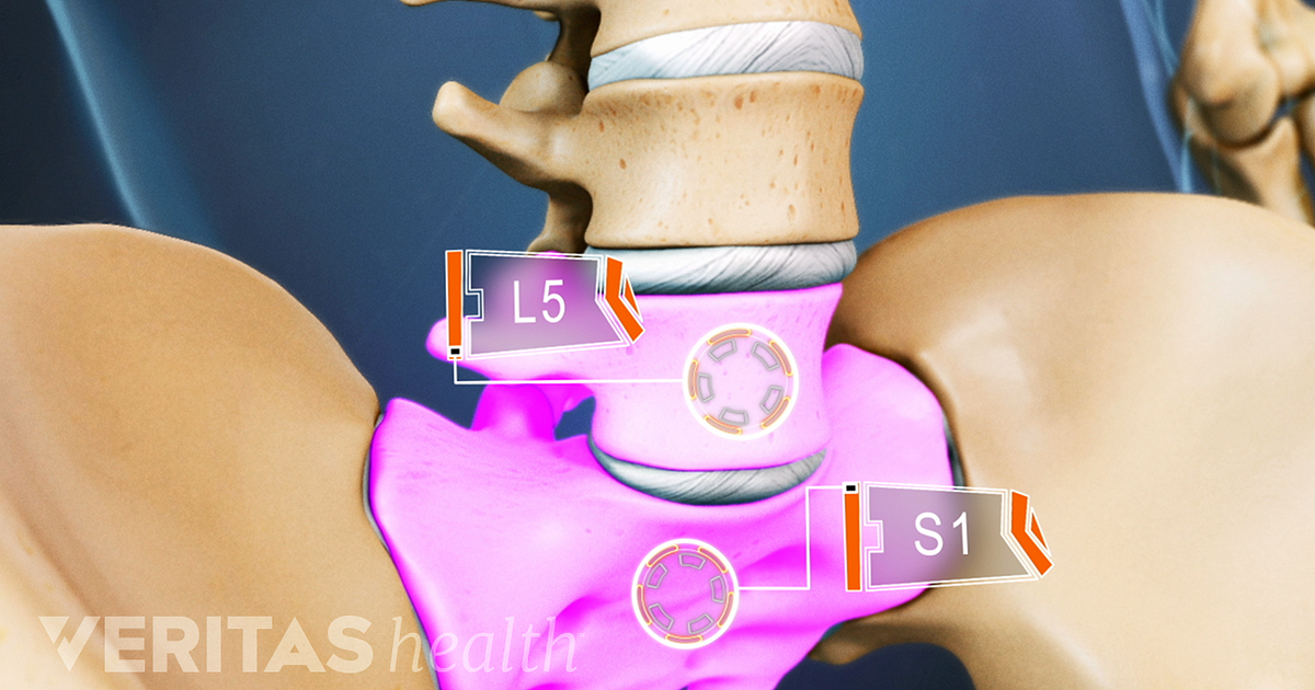 all-about-l5-s1-lumbosacral-joint