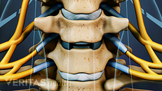 人工颈椎间盘置换术