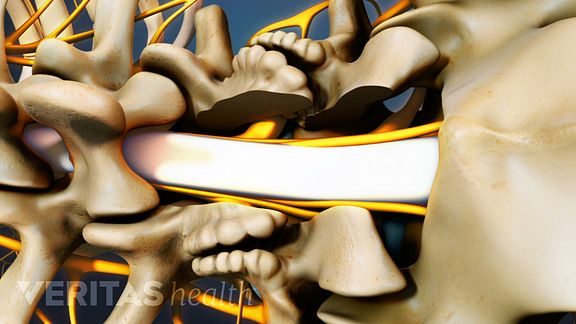 lumbar laminectomy