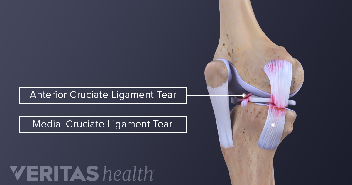 Symptoms Of MCL Sprains And Tears