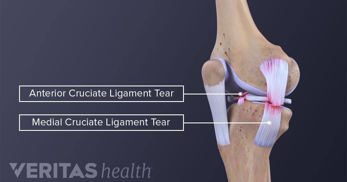 Can You Walk With A Torn Mcl Acl Tear Treatment Options