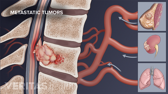 Medical illustration showing a metastatic tumor in the spinal column