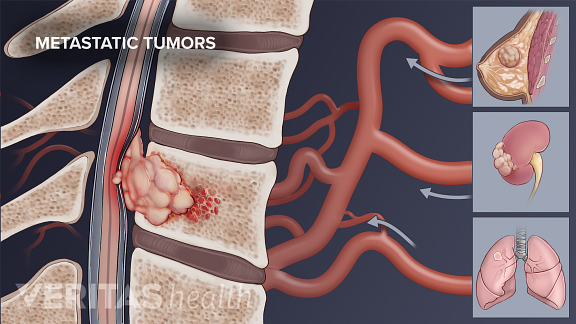 Tumor tulang belakang metastatik