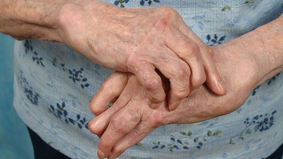 5 Simple Ways To Manage Hand Osteoarthritis