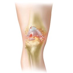 Knee-Arthritic
