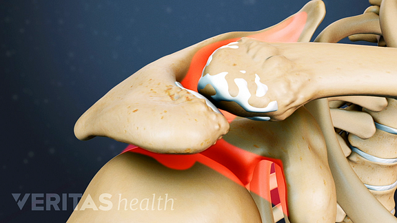 Tratament articular acromioclavicular