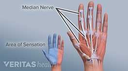 Palmar view of the hand showing areas of sensation caused by the median nerve.