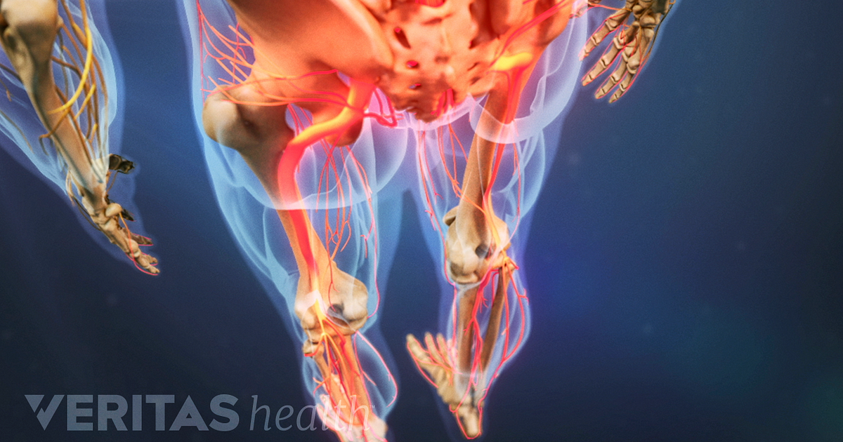 lumbar-radiculopathy