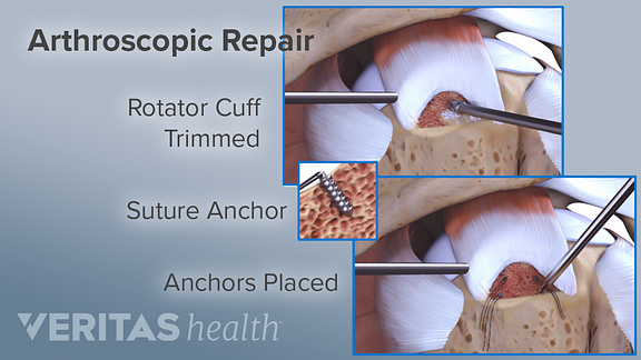 Rotator Cuff Repair Diagram