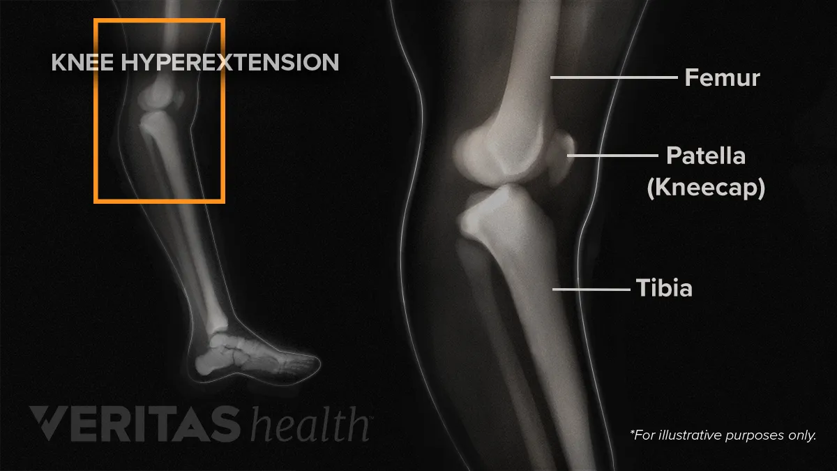 hip knee hyperextension