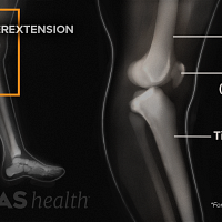 Medical illustration of knee hyperextension x-ray