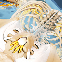 Posterior view of the spine highlighting ankylosing spondylitis in the lumbar spine.