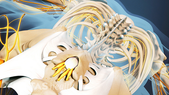 Ankylosing spondylitis video