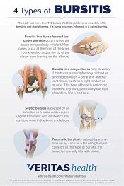 4 Types of Bursitis