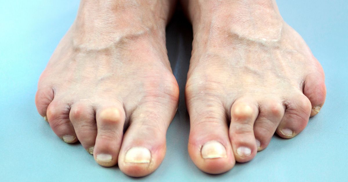 Treating Rheumatoid Arthritis Ra Of The Foot And Ankle