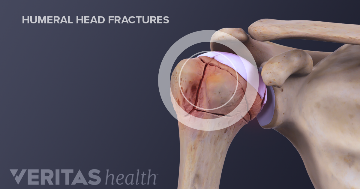 The 3 Types of Shoulder Fractures