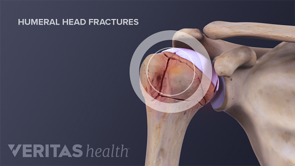 Humeral head fractures in the shoulder