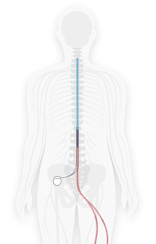 https://embed.widencdn.net/img/veritas/vi08suw43m/504x788px/spinal-cord-stimulator-illustration.png?keep=c&crop=yes