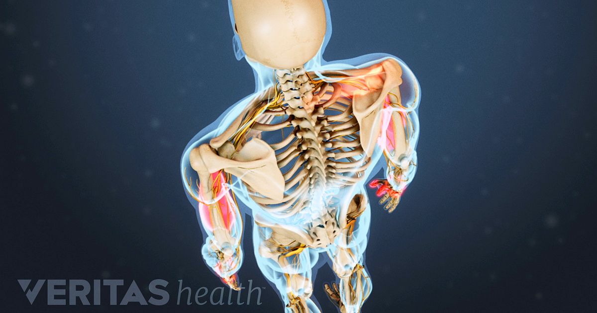 What Is Cervical Radiculopathy?