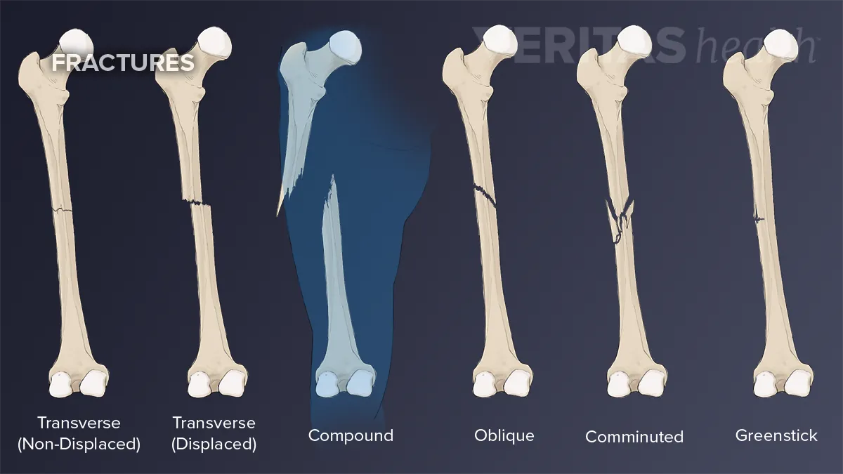 Bone Fractures Symptoms Types And Treatment From Doct - vrogue.co
