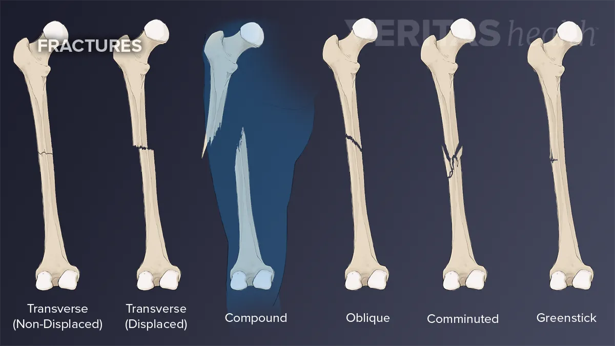 oblique fracture