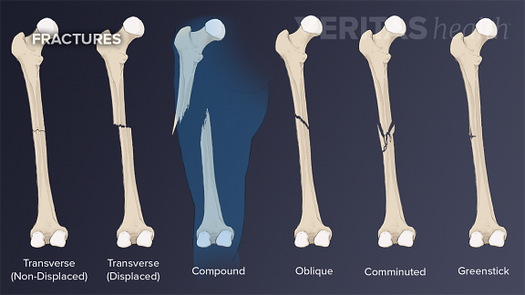 Different types of fractures illustrated along the femur