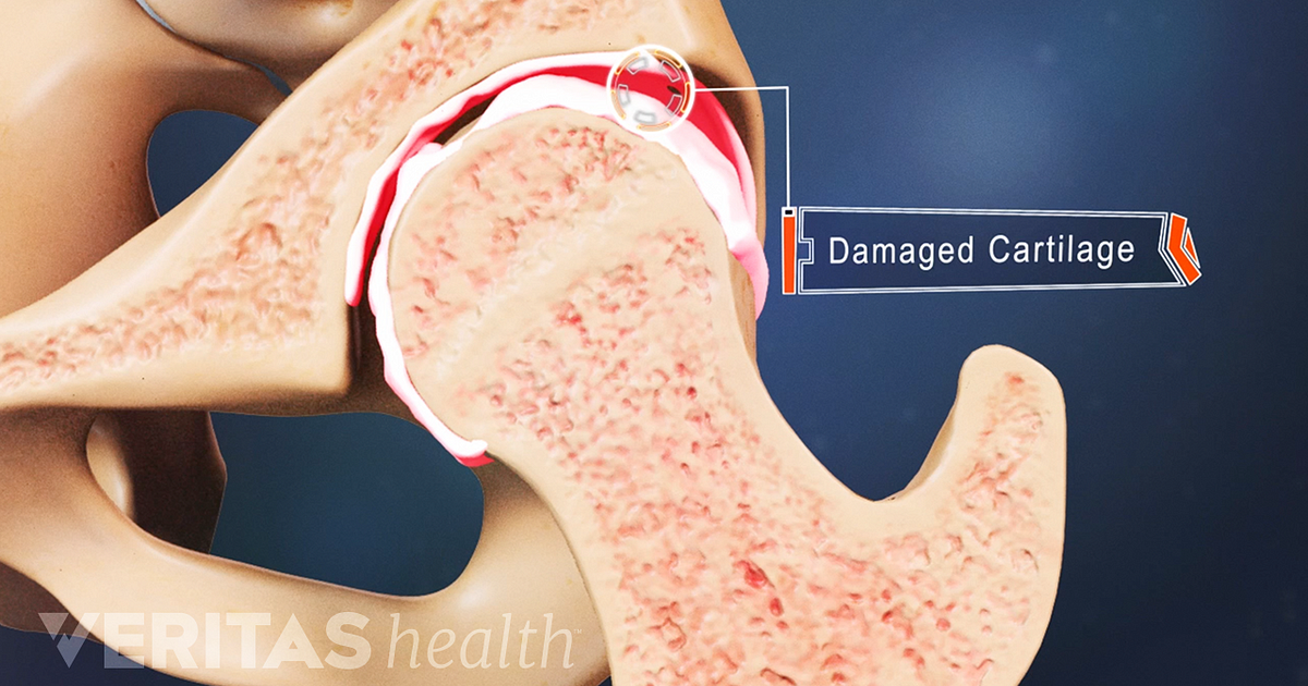 5 Risk Factors for Hip Arthritis Biology Diagrams