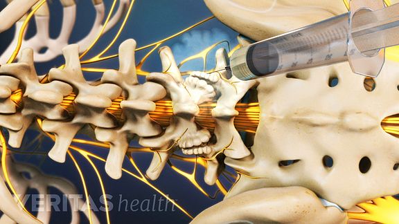 Lumbar Radiofrequency Neurotomy Anesthetic
